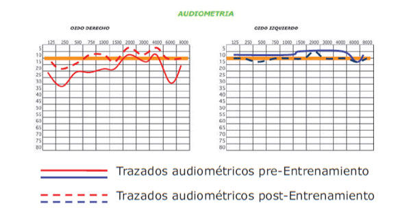 Gràfiques auditives abans i després del tractament